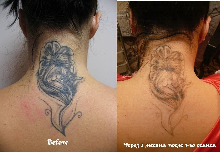 Лазерное удаление татуировок в Санкт-Петербурге: цены, видео, отзывы