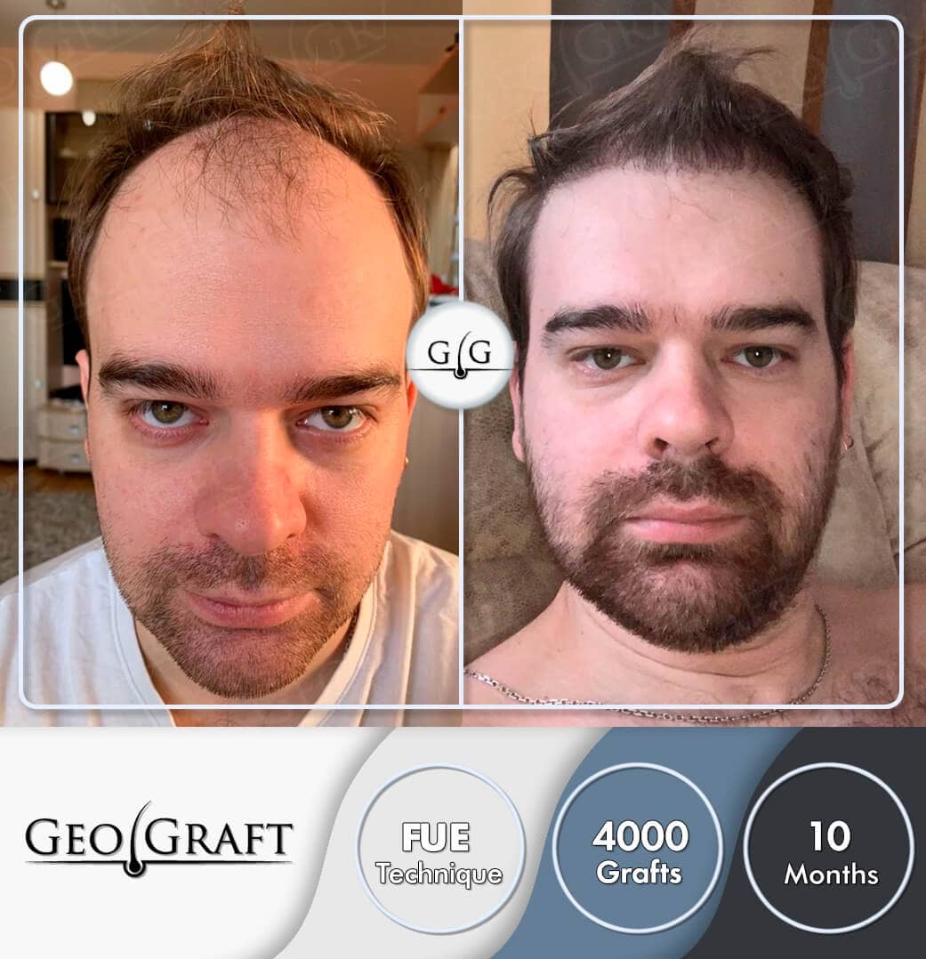 Пересадка волос в Москве. Geograft. Без боли - за один день.