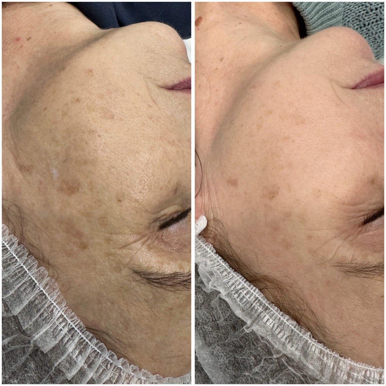 Фото до и после: удаление пигментации лазером в клинике PradusCOSMO, Санкт-Петербург. Безопасная процедура с гарантией результата