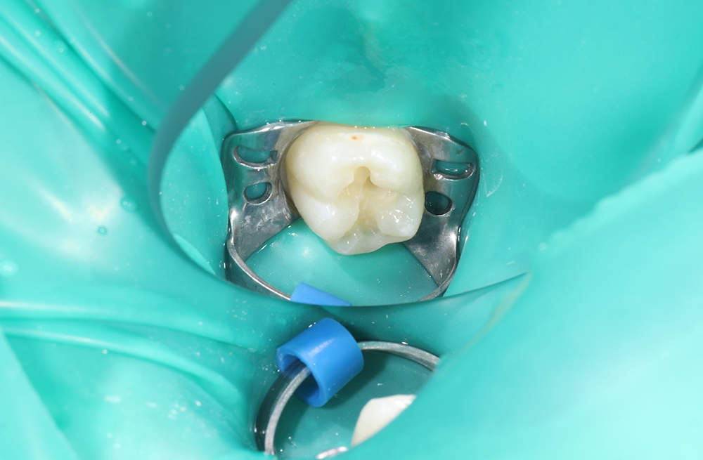 Лечение среднего кариеса постоянного зуба ребенку 8 лет