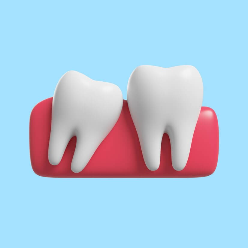 Основные симптомы появления зубов «мудрости» - центр стоматологии «Тихонова» в Туле