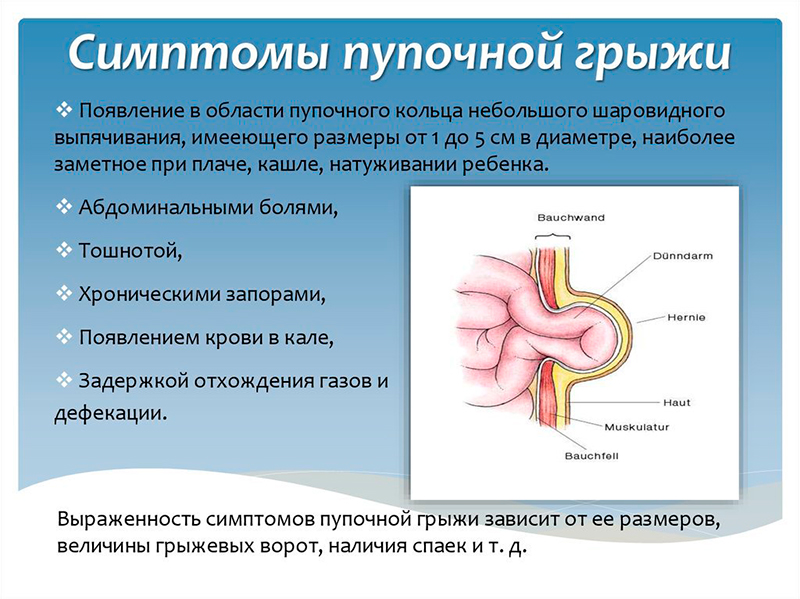 Пупочная грыжа – Симптомы, диагностика и лечение в МЦ «Доктор Боголюбов»