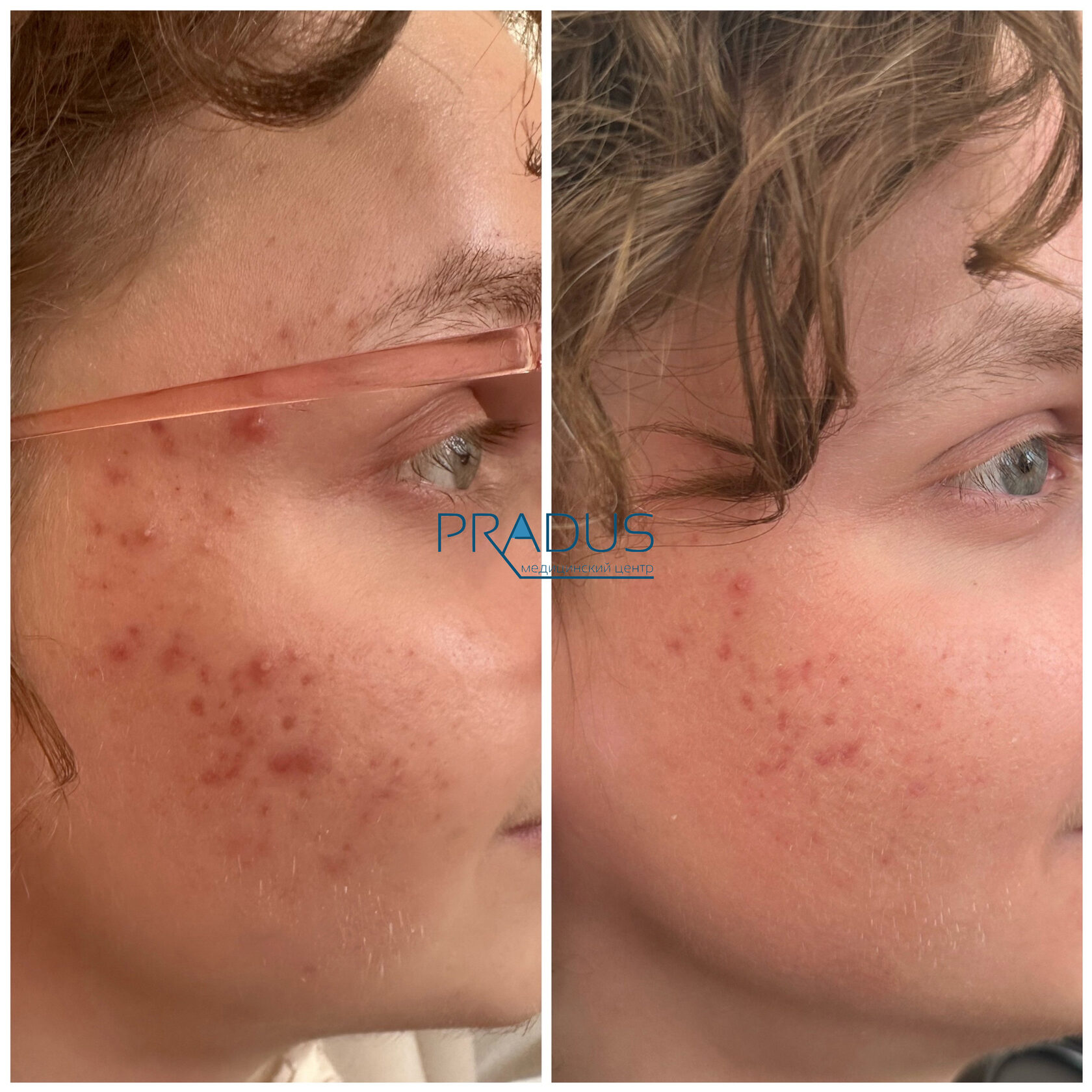 Лечение акне у женщины в клинике PradusCOSMO, СПб. До и после процедуры