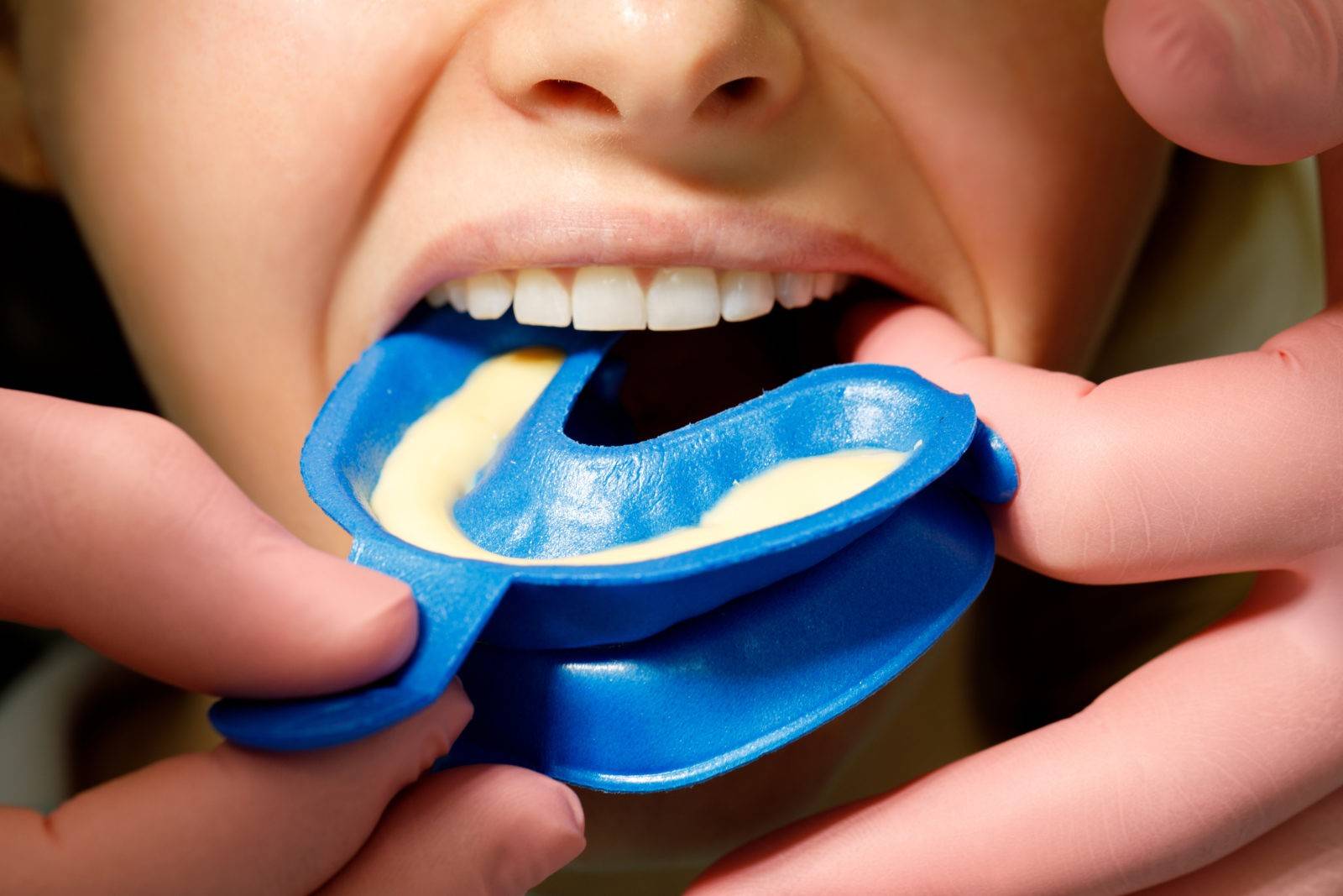 Фторирование молочных зубов у детей