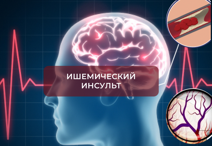 Последствия сужения сосудов головного мозга. Диагностики патологии сосудов головного мозга. Какой вид ишемии развивается при тромбозе артерии.