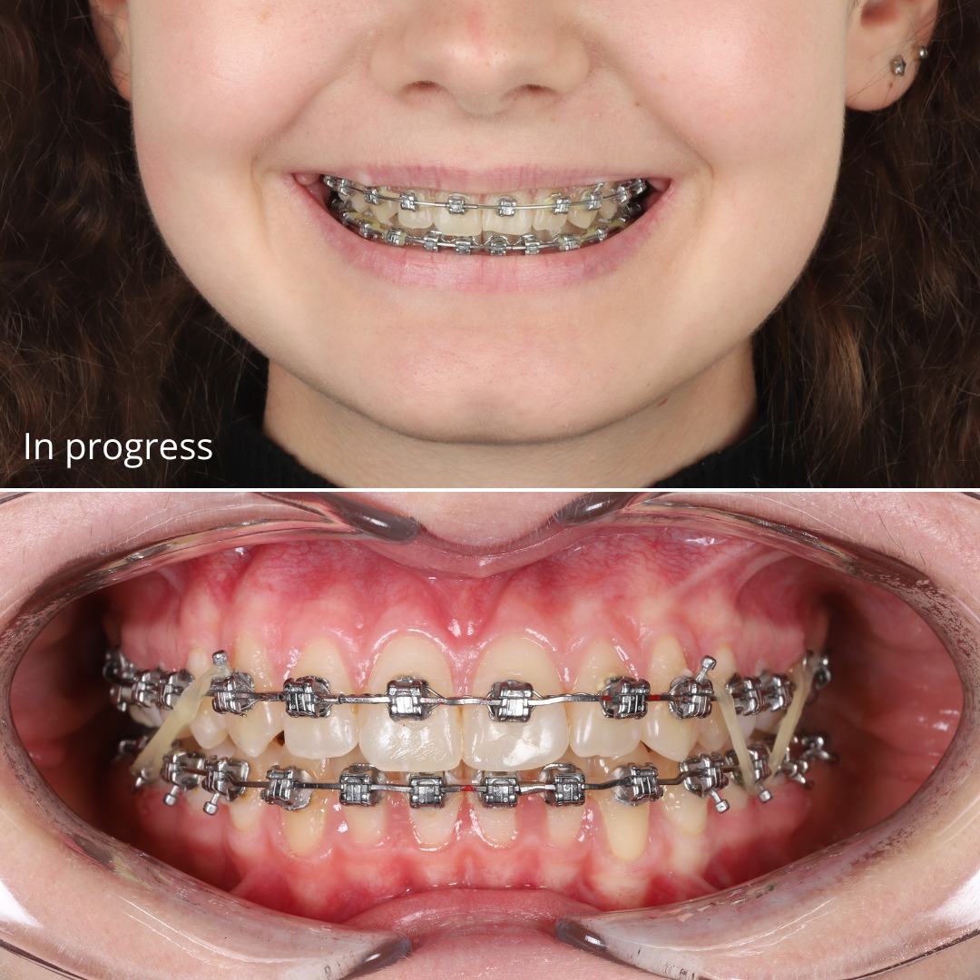 Near-completion view showing corrected bite and aligned dental arches — photo 5 of 6