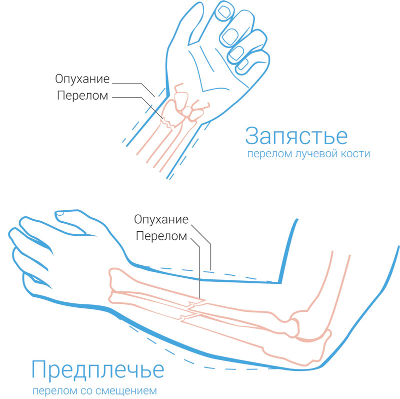 Перелом предплечья симптомы. Запястье предплечье. Как сломать предплечье. Трещина предплечья как определить. Электрофорез предплечья и кисти.