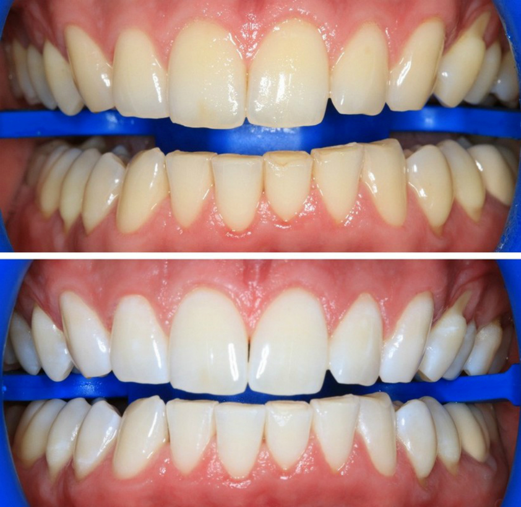 Фото зубы до и после отбеливания зубов зубные щетки типа curaprox
