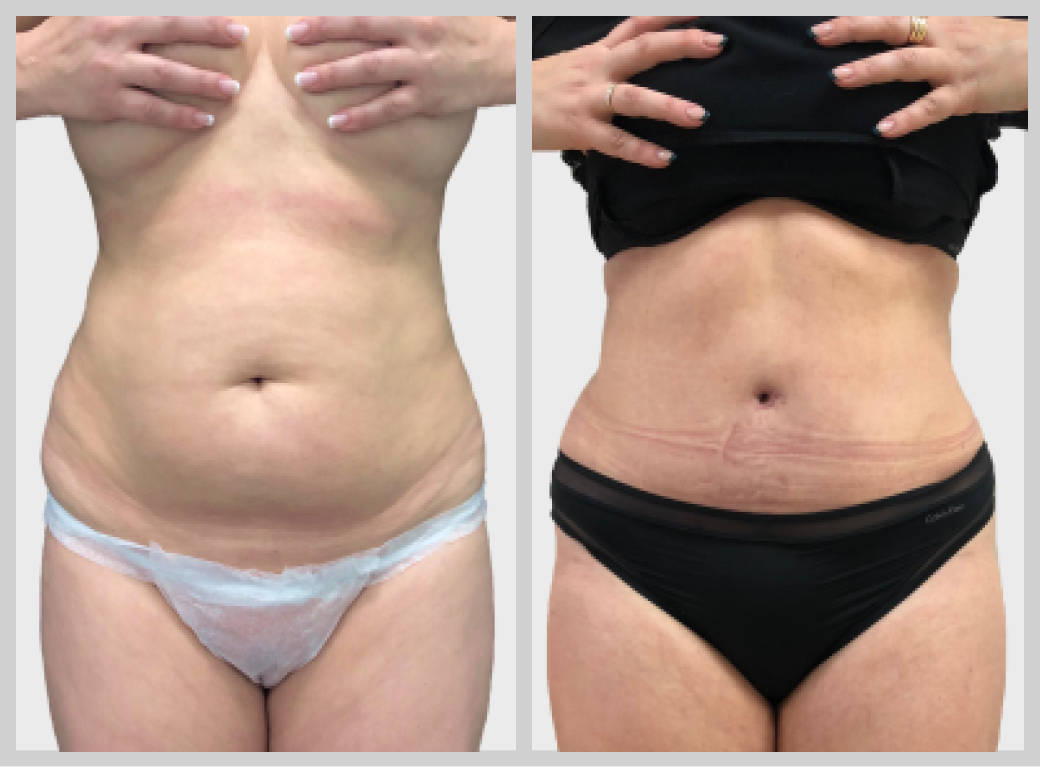 абдоминопластика липосакция живот