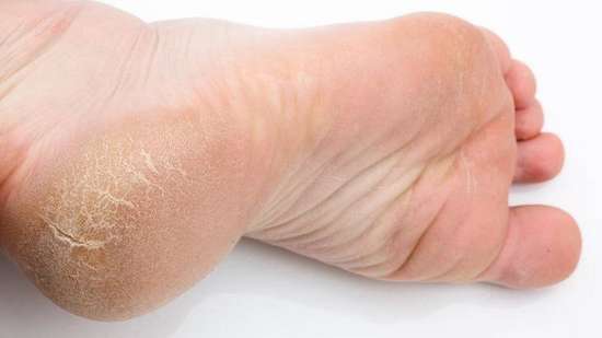Причины появления грубой кожи на пятках и стопах