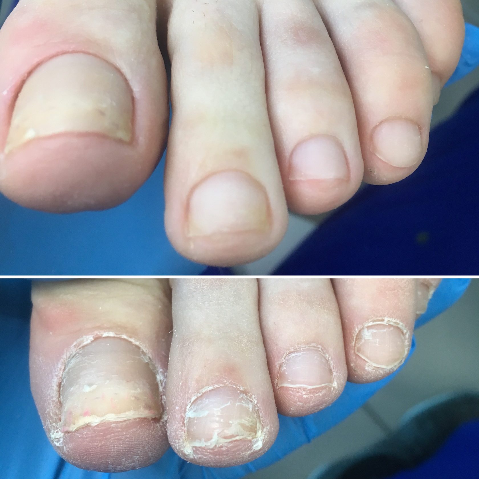 Исправление ногтевой пластины