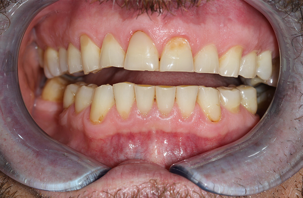 Керамические виниры E-max на все зубы