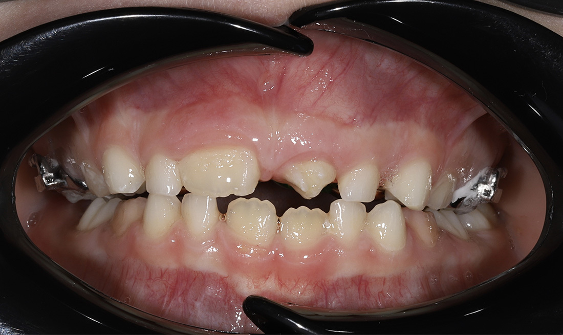 Комплексное ортодонтическое лечение ребенка 8 лет со сверхкомплектным центральным резцом