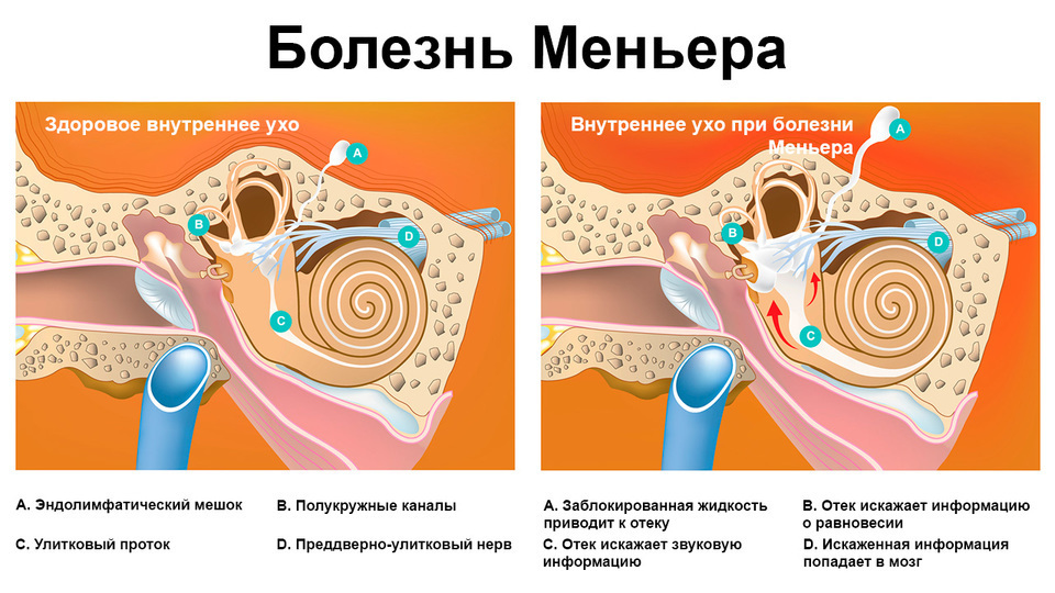 Всё, что нужно знать о болезни Меньера