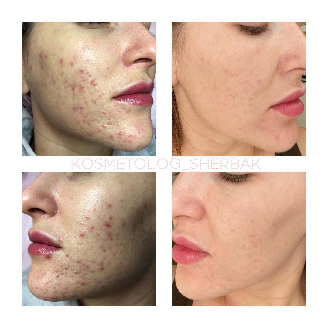 Лечение акне у женщины в клинике PradusCOSMO, СПб. До и после процедуры