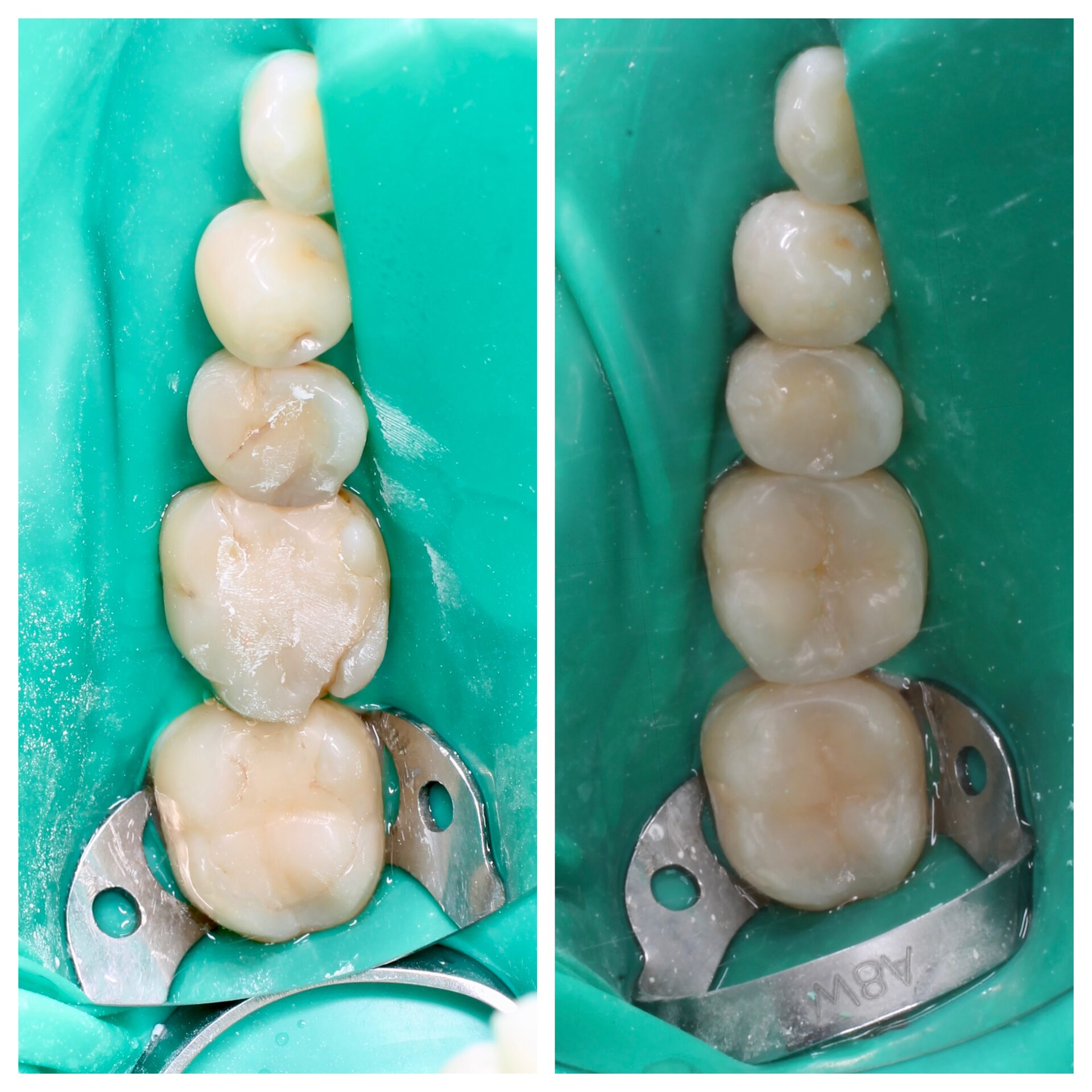 лечение зубов в чебоксарах,стоматология чебоксары, лечение кариеса в чебоксарах,стоматология отзывы, лечение зуба под микроскопом в чебоксарах