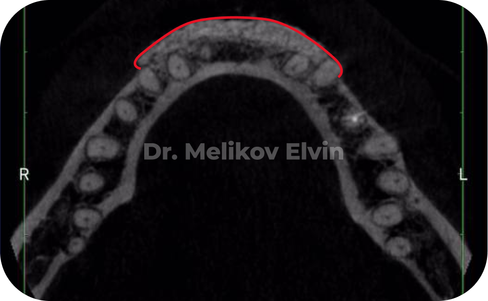Снятие оттиска трансфером для открытой ложки