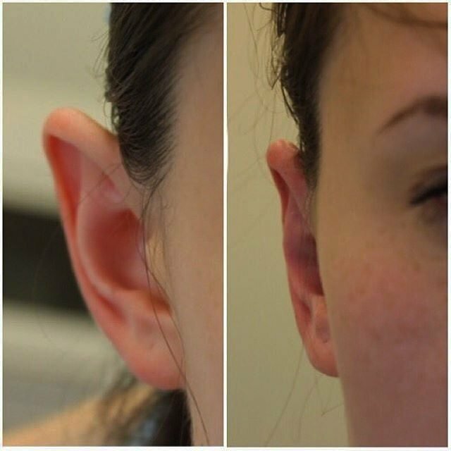 Отопластика