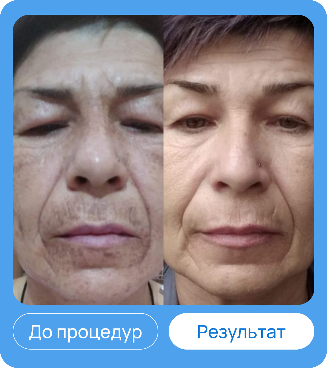 Аппараты холодной плазмы. PLASMA LINER ACADEMY