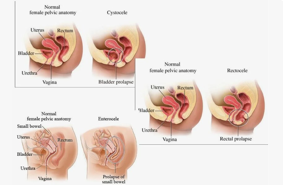 Prolapse Anime