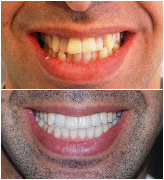 Изменение формы зубов. Ровные зубы.