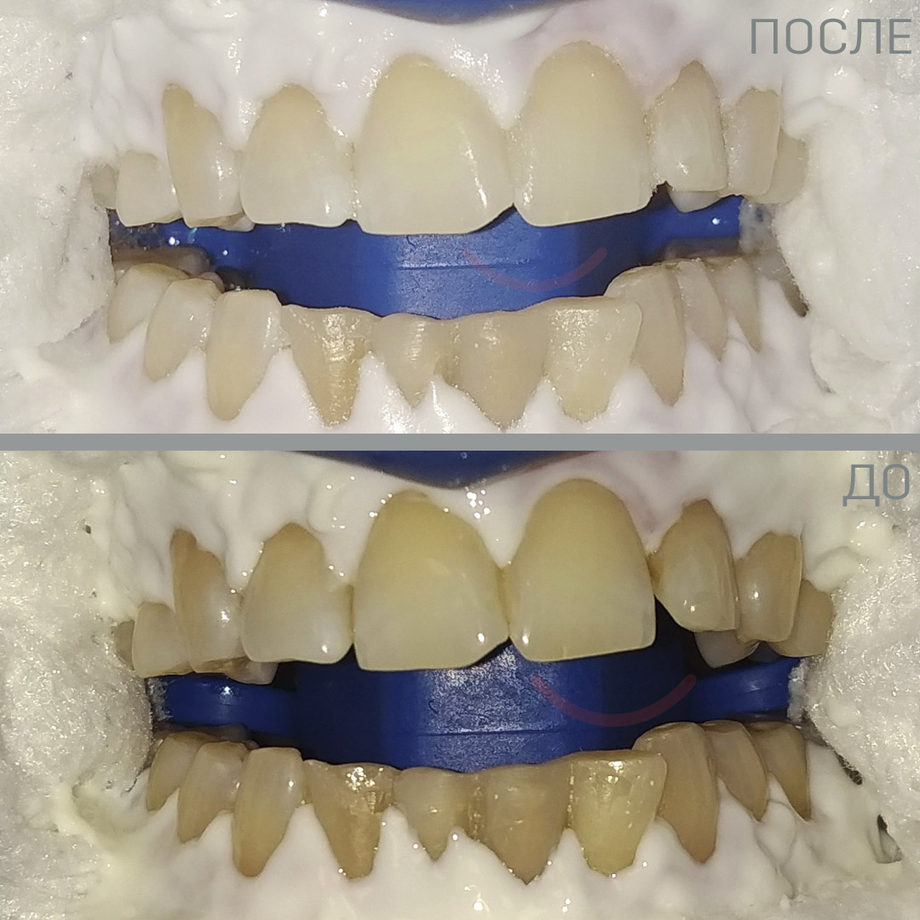 РУМЕНТИ: Отбеливание зубов 