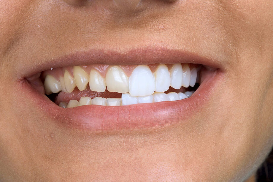 Модели зубов фото