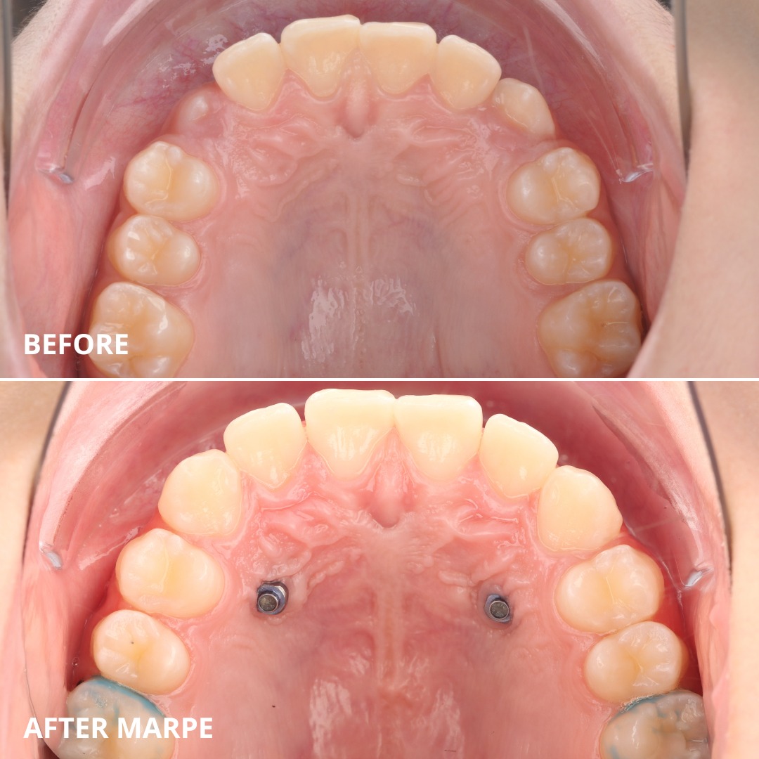 Stage progress showing improvement in the anterior reverse overlap — photo 4 of 7