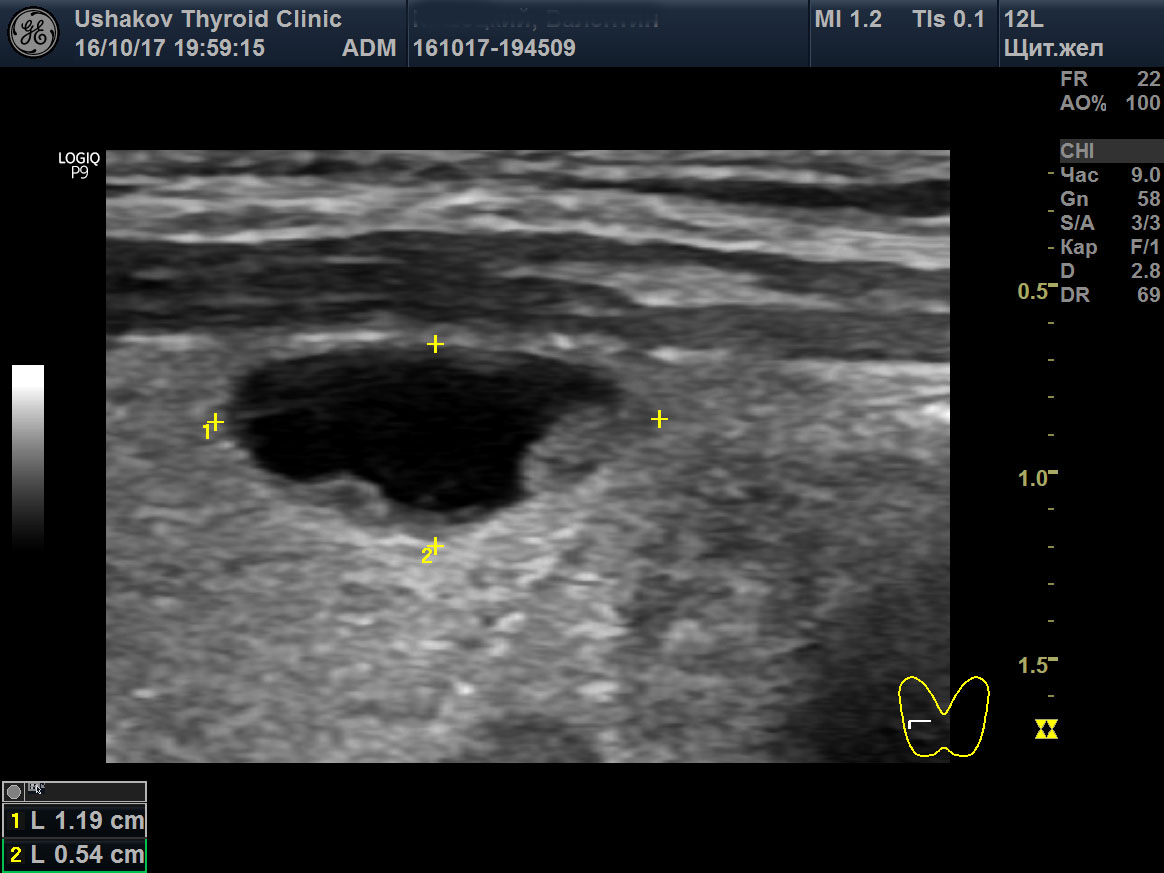 Фото узи щитовидной железы с узлом