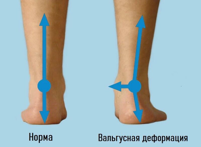 Вальгусная деформация стопы у ребенка: что это такое, лечение и причины искривления ноги