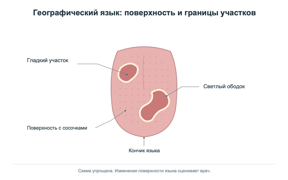 Схематичные изменения поверхности при географическом языке
