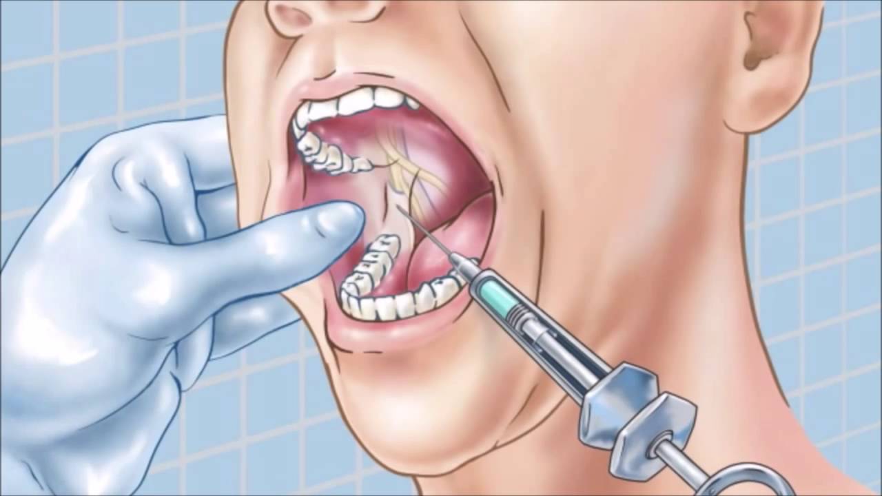 Больно лечить зубы даже с анестезией Покрытие зубов фторлаком Томск Лебедева
