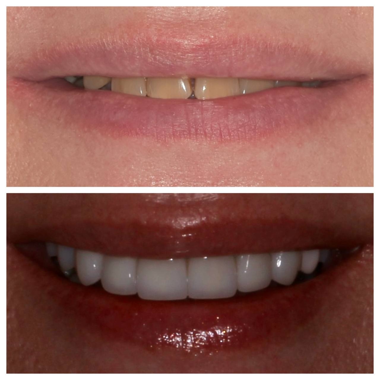 имплантация зубов чебоксары,имплантация зубов йошкар-ола,тотальная реабилитация на 6 имплантатах,протез несъемный в чебоксарах,виниры чебоксары,виниры йошкар ола, коронки на импланты,имплантация зубов чебоксары