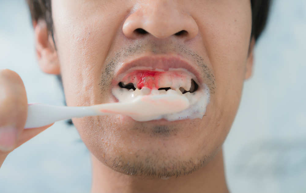 Кровоточивость при чистке зубов