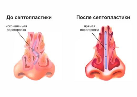 Септопластика носа: перегородка носа до и после операции — схема