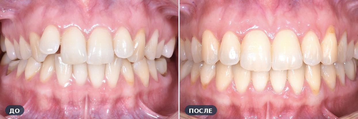 Ортодонтическое лечение: Скученность передних зубов — до и после