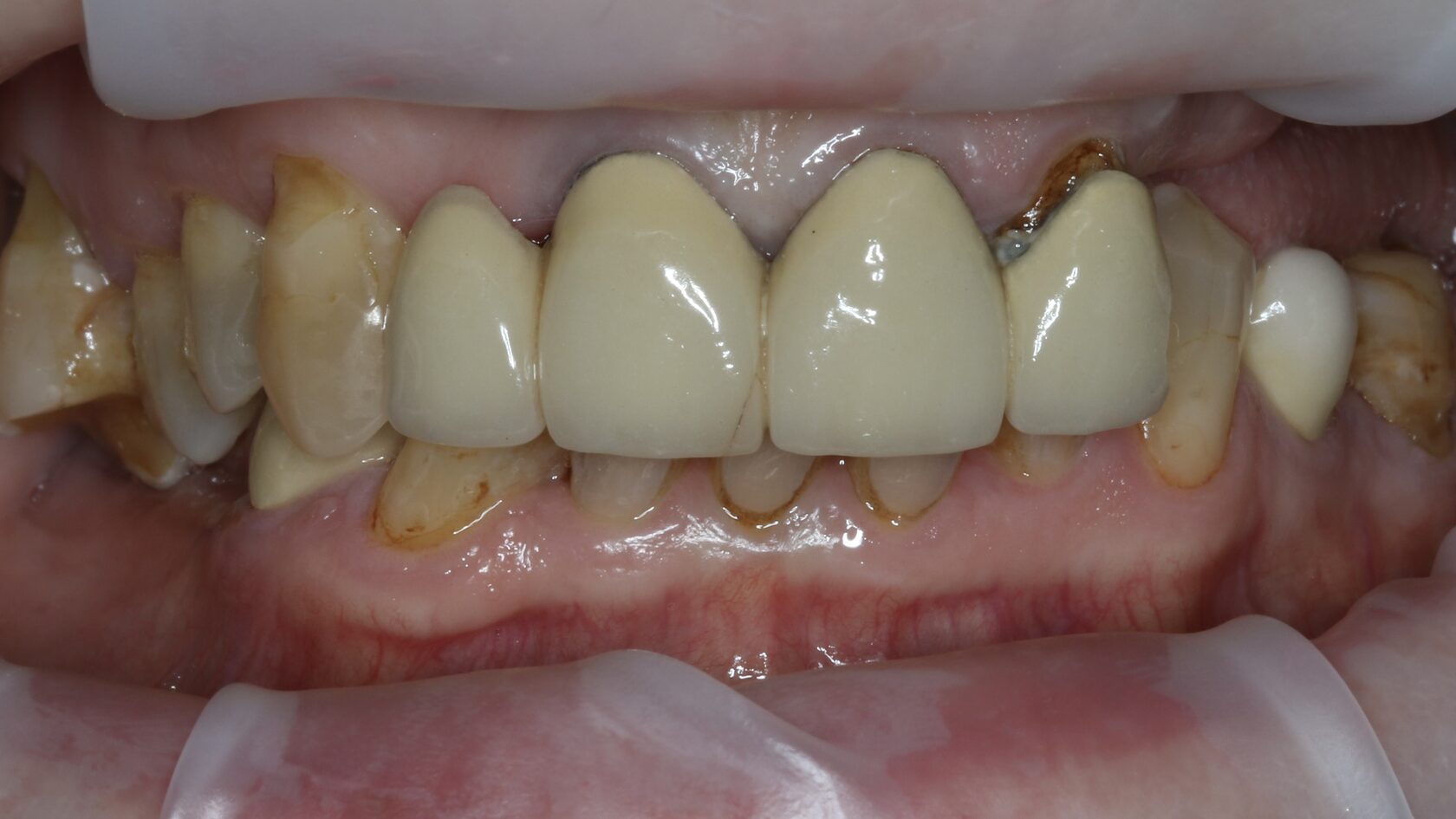 Как сохранить зубы здоровыми после 40, 50 и 60 лет