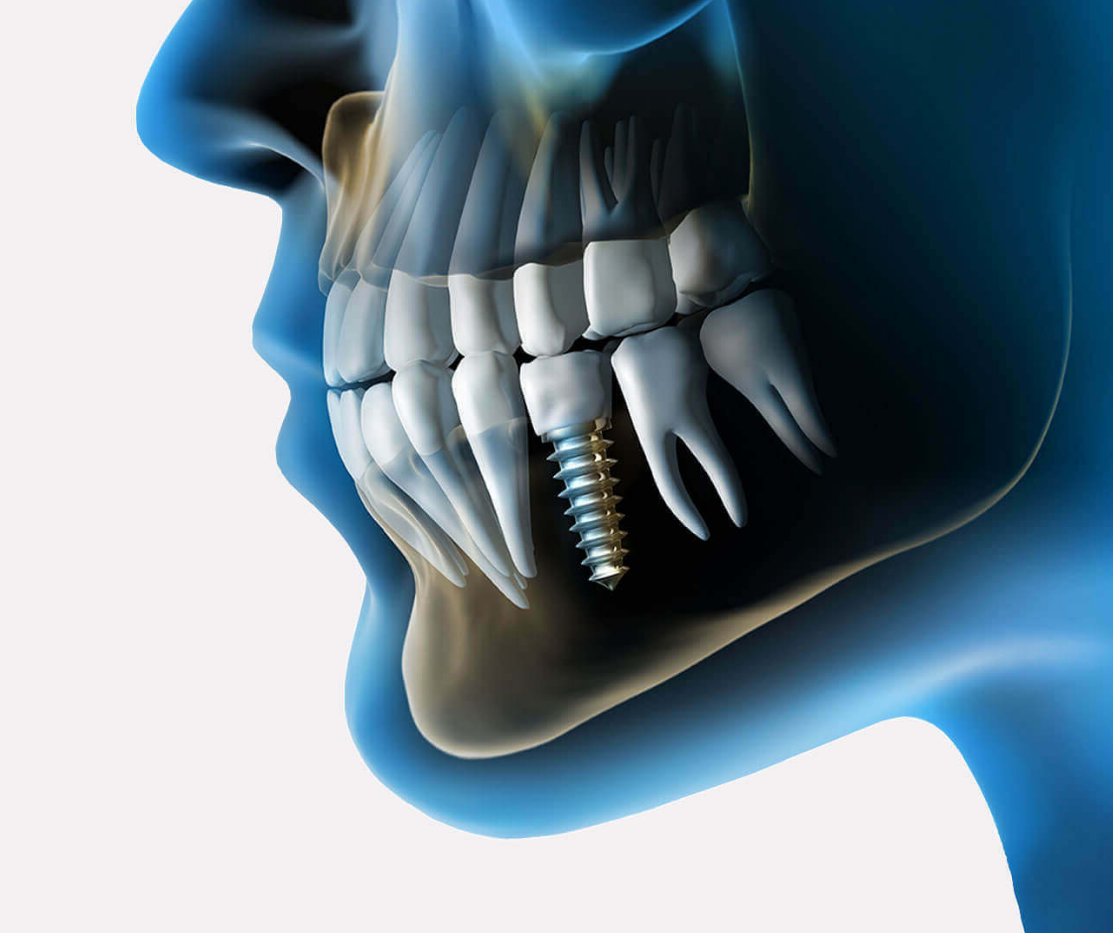 Трехмерный снимок зубов. Стоматология имплантация.