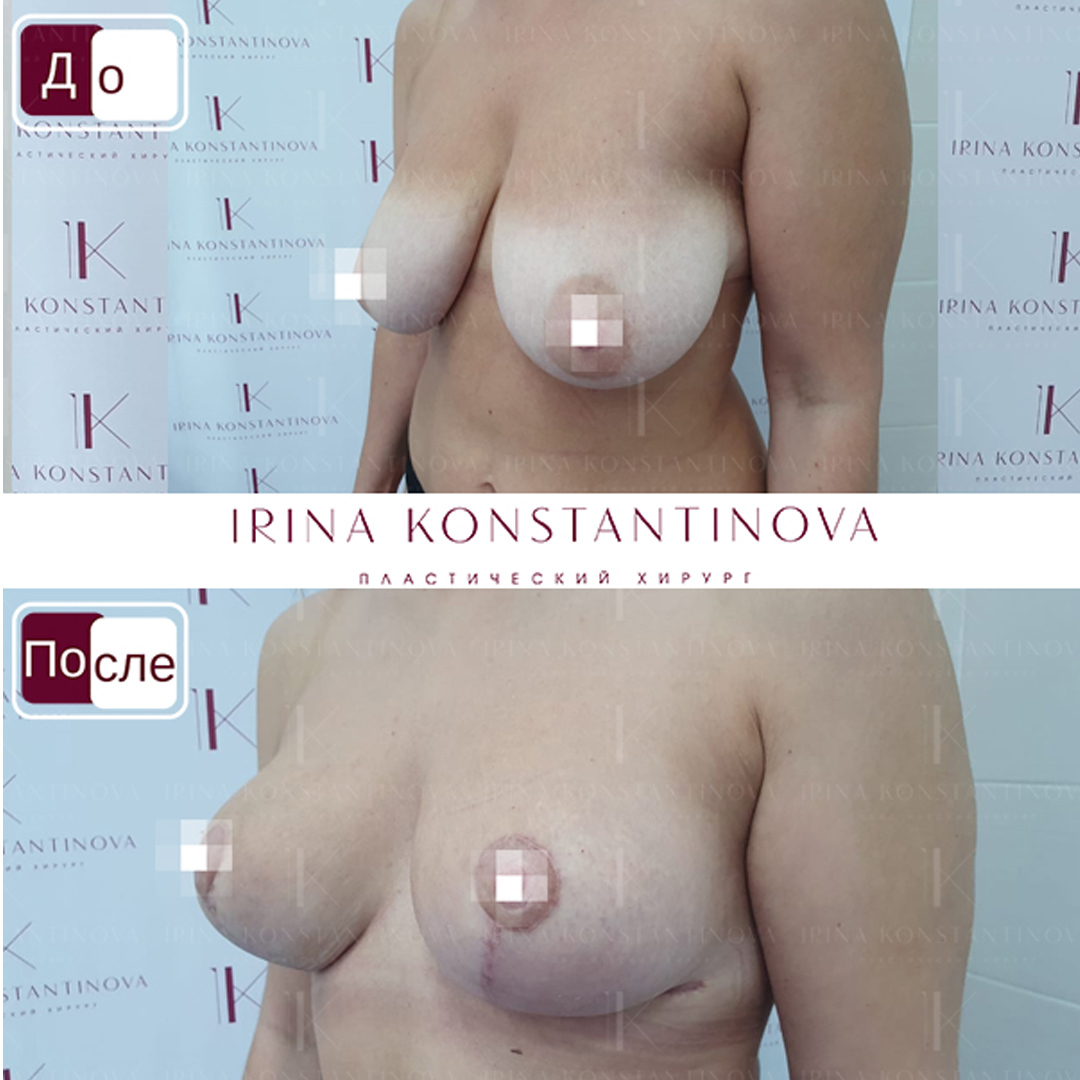 удаление и восстановление груди в одну операцию фото 113