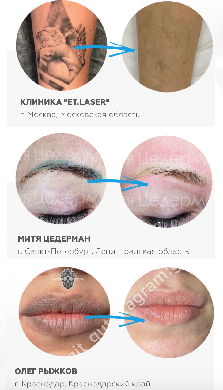 Онлайн обучение лазерному удалению татуажа и тату