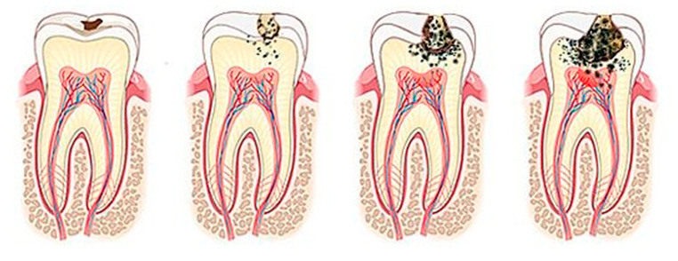 Методы удаления нерва в зубе без боли