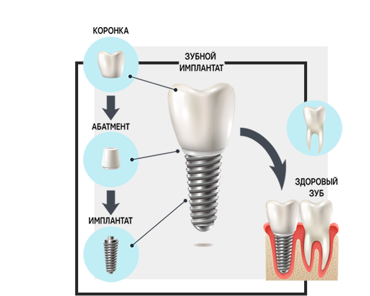 Чем отличается зубной. Имплант винт абатмент коронка. Циркониевая коронка на имплант Osstem. Схема имплант абатмент коронка. Схема установки зубного имплантата.