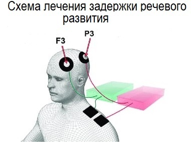 Ткмп схема наложения электродов