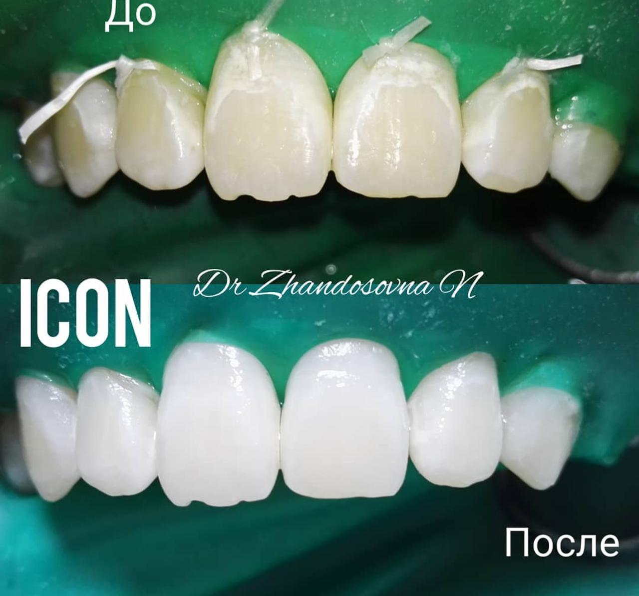 Айкон в стоматологии до и после
