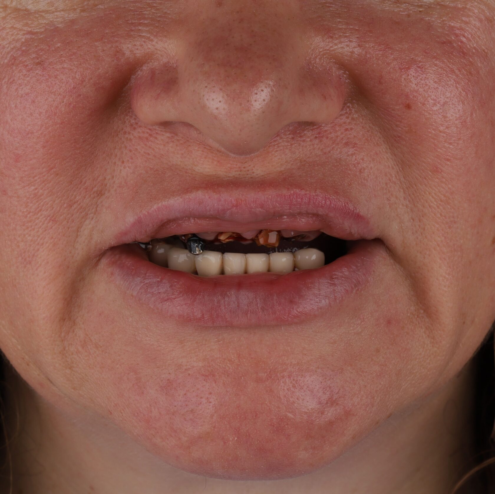 All +on +4, All +in +4 имплантация, протезирование, вернуть зубы, протезирование на имплантах, всё-на-4, все-на-четырех, протезирование зубов