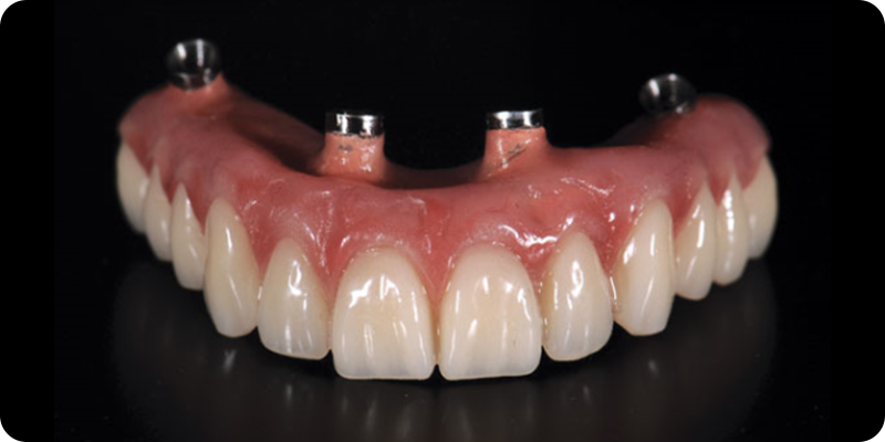 Пример будущей ортопедической конструкции