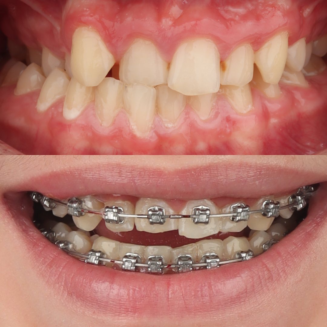 Before treatment view showing the maxillary arch prior to MARPE skeletal expansion