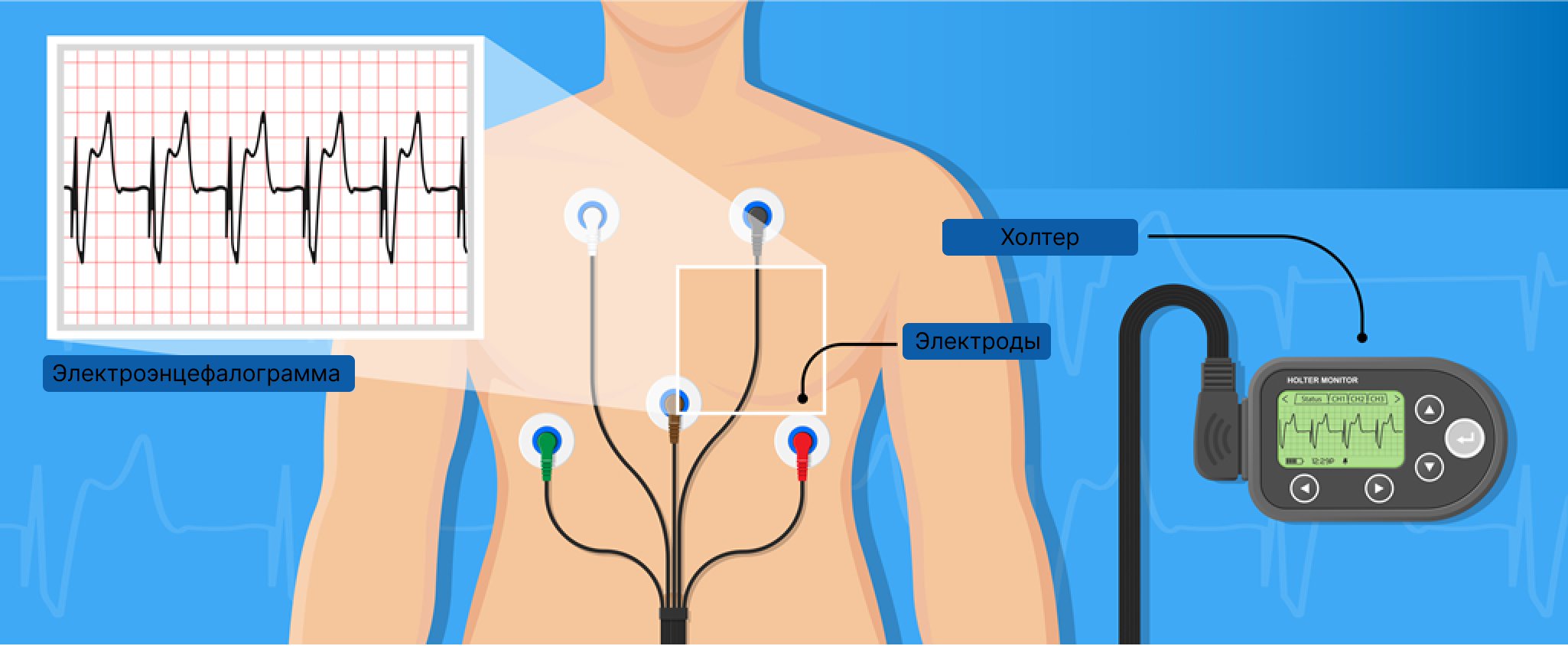 Датчики холтера схема. Холтеровское мониторирование электроды схема. Суточный монитор ЭКГ. 12 Канальный Холтер наложение электродов. Холтер ЭКГ наложение электродов.