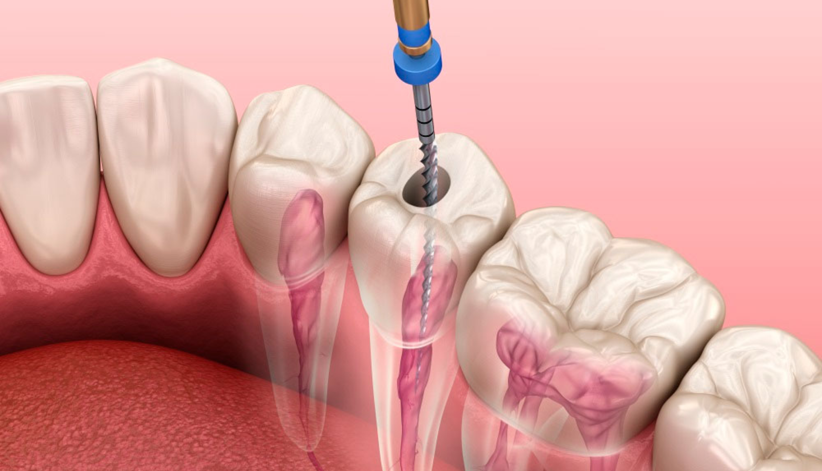 Сколько ходят с лекарством в зубе. Эндодонтическое перелечивание зубов. Пульпит корневого канала.