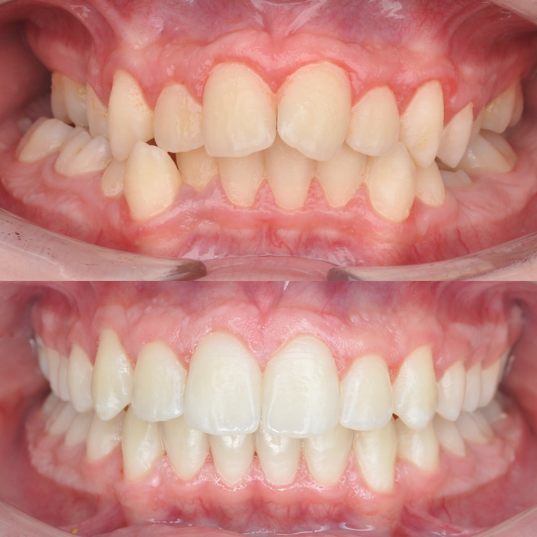 Before treatment view showing the transverse maxillary deficiency prior to MARPE RPE